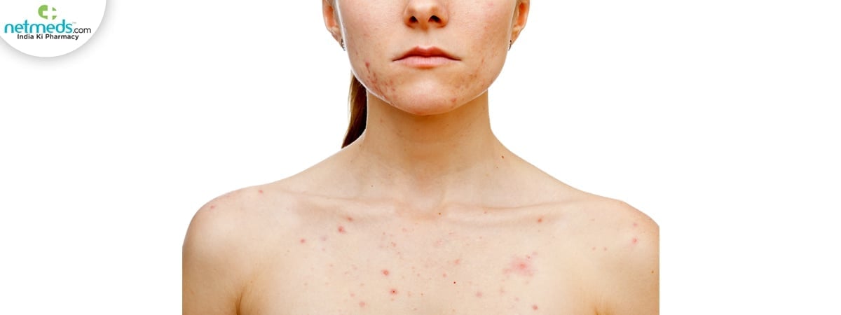 chest acne causes
