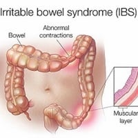 Do I Have Irritable Bowel Syndrome?