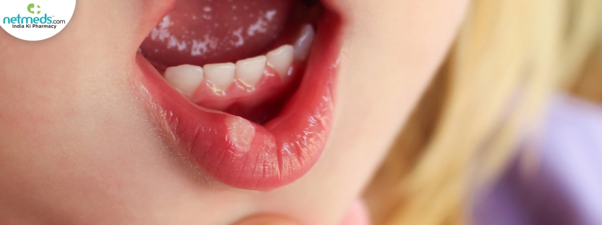 mouth ulcer