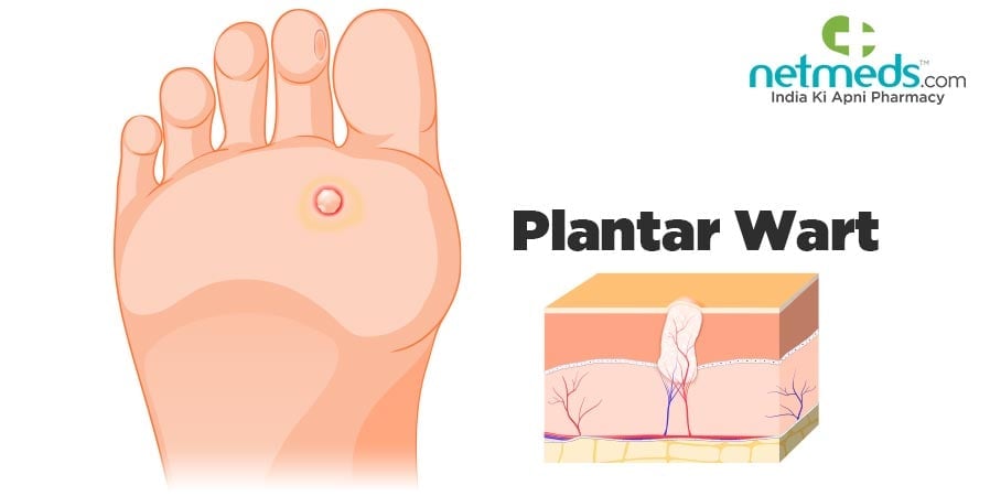 Plantar Wart