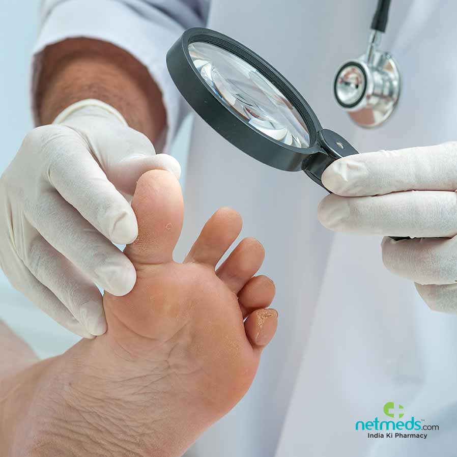 Foot Fungal Infection