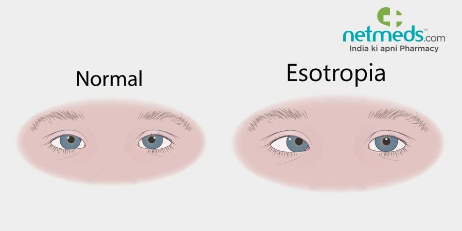 Esotropia