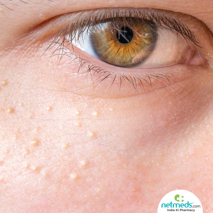 milia or milk spots