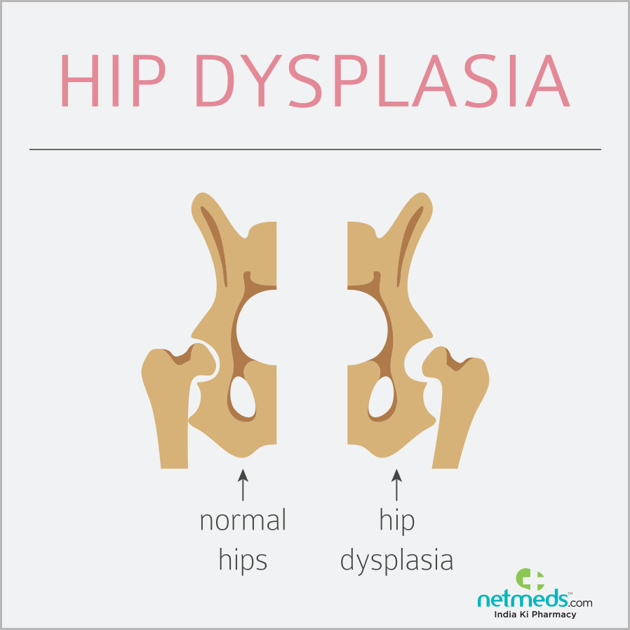 hip dysplasia symptoms and treatment
