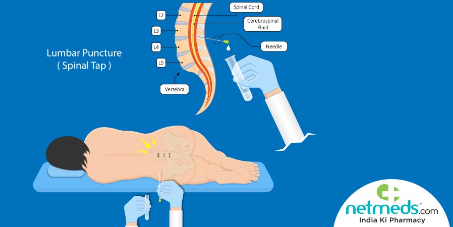Lumbar puncture (spinal tap)