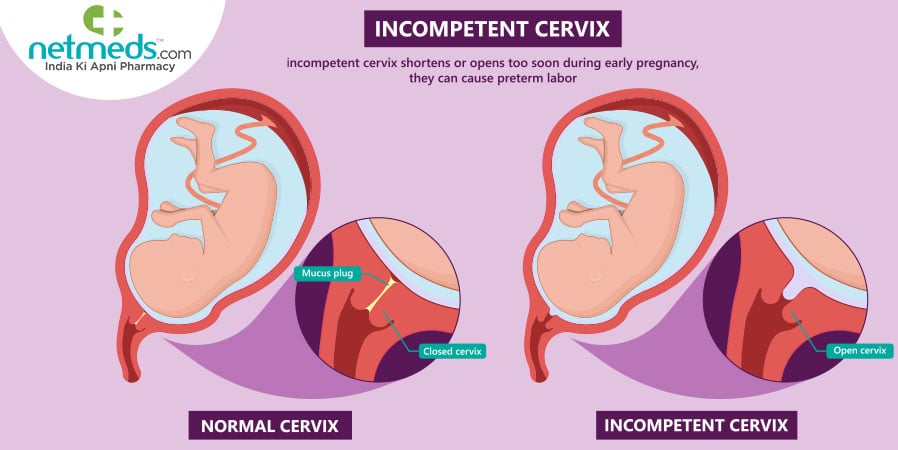 Incompetent Cervix