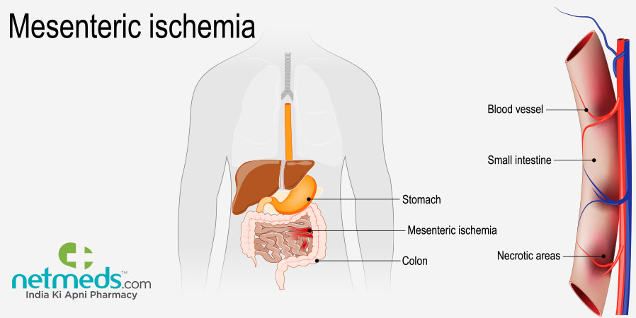 Mesenteric Ischemia