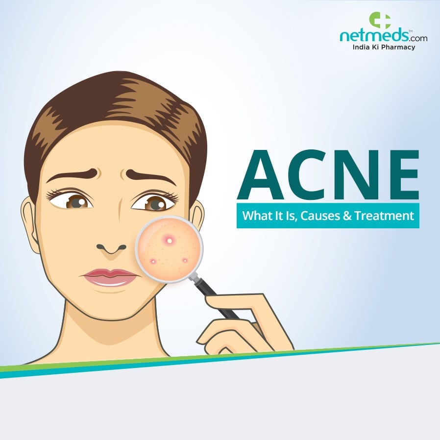 Acne: Causes & Treatment