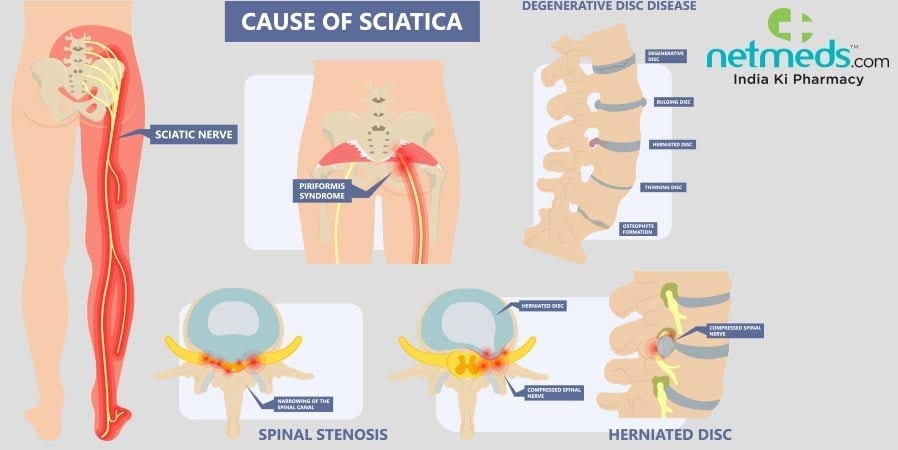 Cause of Sciatica