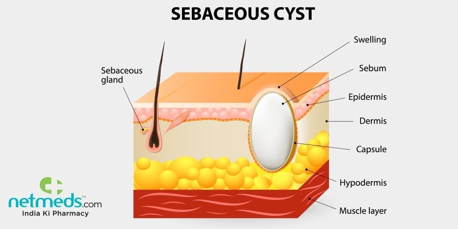 Sebaceous cyst