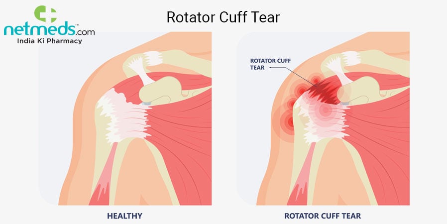 Rotator cuff tear