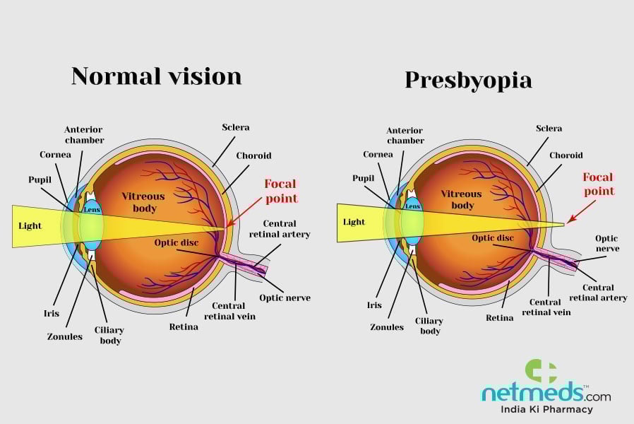 presbyopia