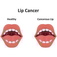 Lip Cancer: Causes, Symptoms And Treatment