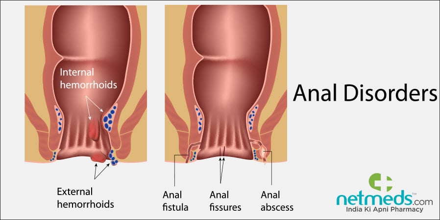 Anal disorders