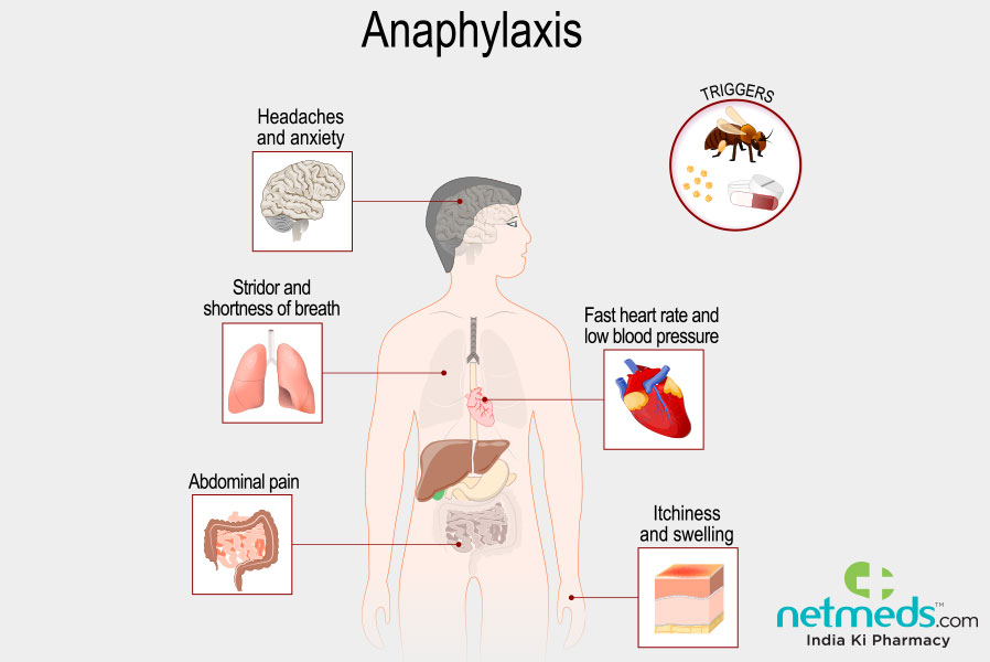 anaphylaxis