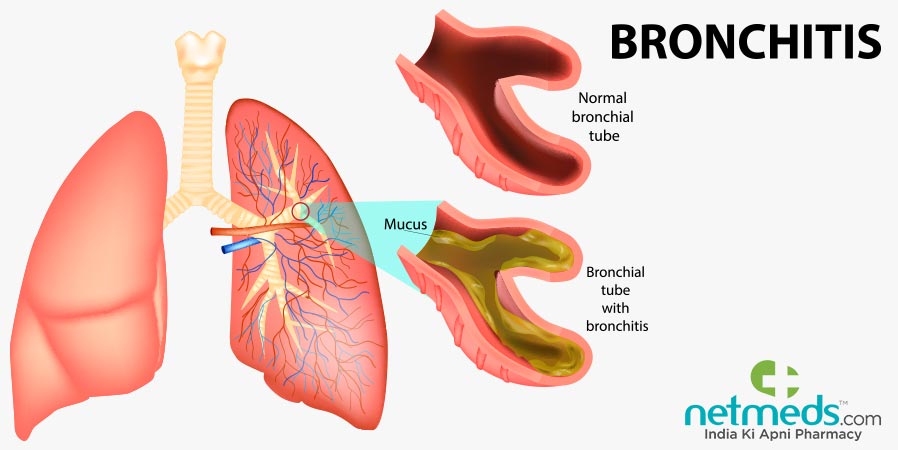 Bronchitis