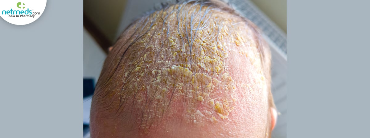 cradle cap