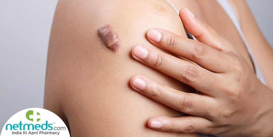 Keloid