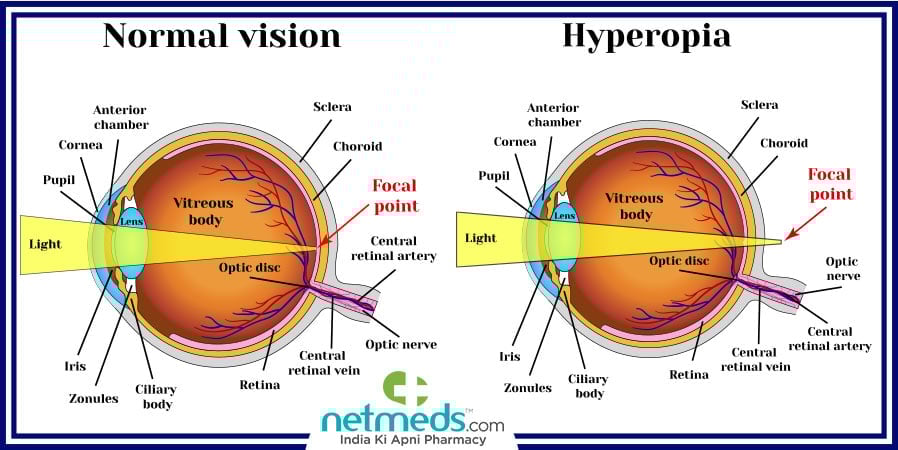 Hyperopia