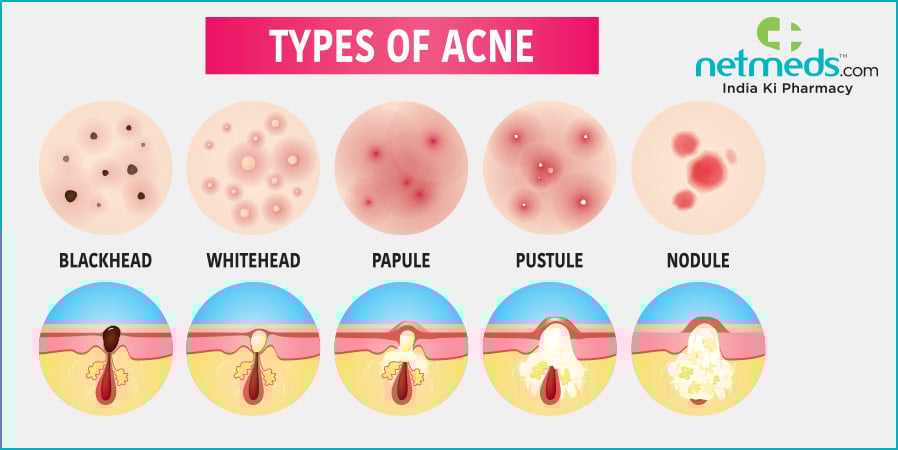 types of acne