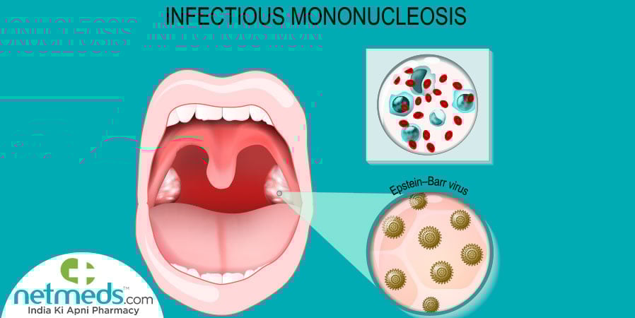 Infectious Mononucleosis