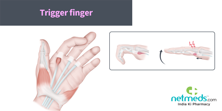 Trigger finger