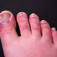 Covid Nails: Know All About This Symptom While Recovering From Covid-19
