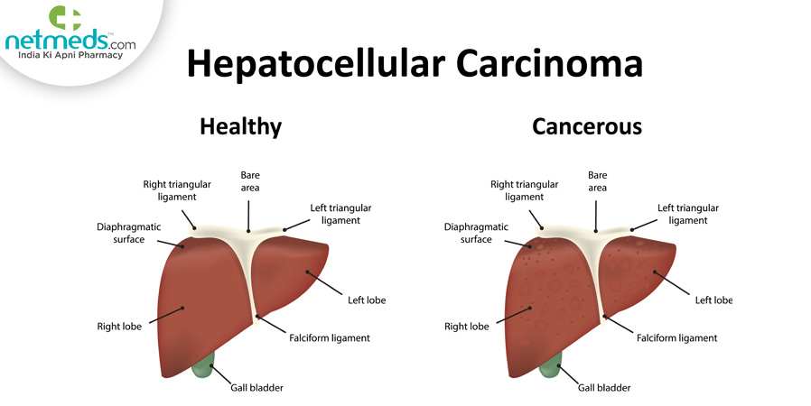 Hepatocellular carcinoma
