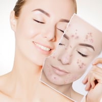 Comedonal Acne: Know All About This Skin Condition And Incredible OTC Ingredients To Treat Them At Home