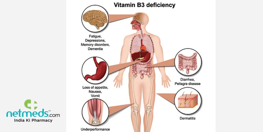 Pellagra: Vitamin B3 Deficiency