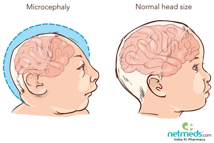 microcephaly