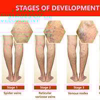 Varicose Eczema: Causes, Symptoms And Treatment