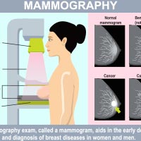 Mammography: What Is It And What To Expect?