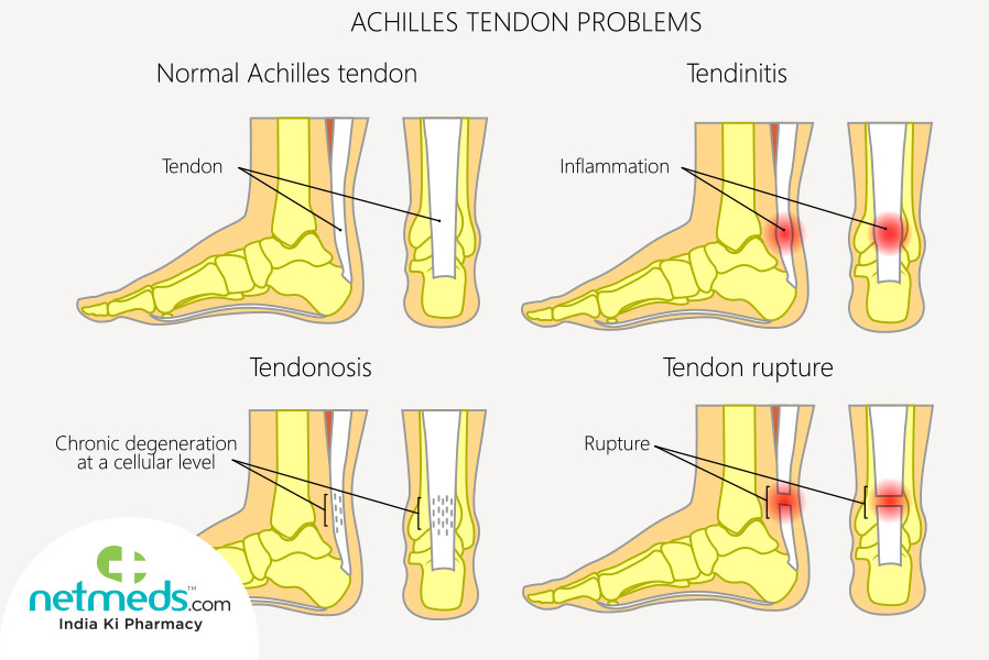 tendinitis