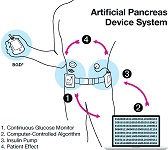 Artificial Pancreas Device System