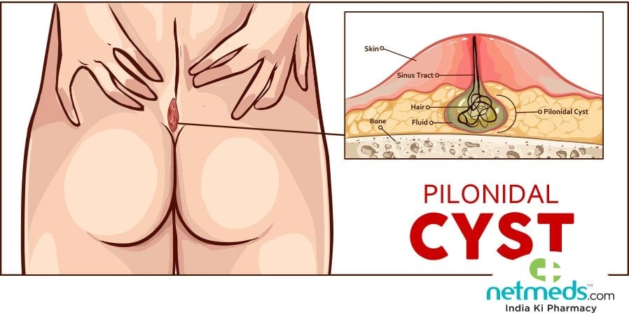 Pilonidal cyst