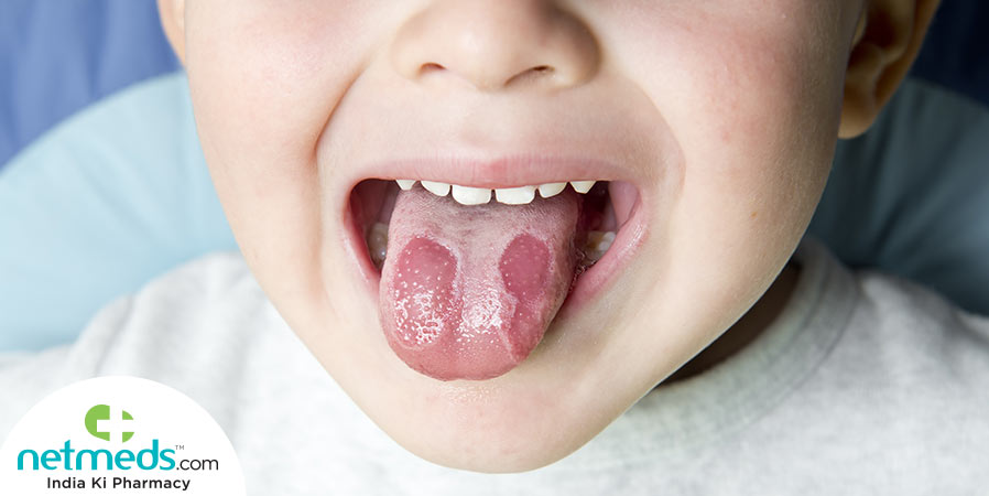 Geographic Tongue