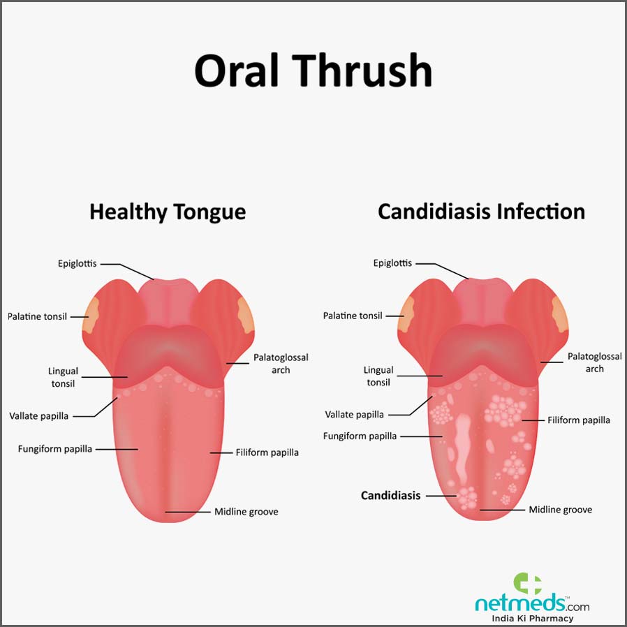 oral thrush or candidiasis