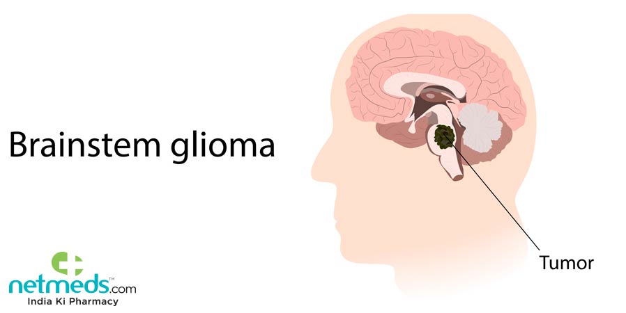 Brainstem Glioma