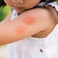 Don’t Ignore Fever, Fatigue; It Could Be Dengue