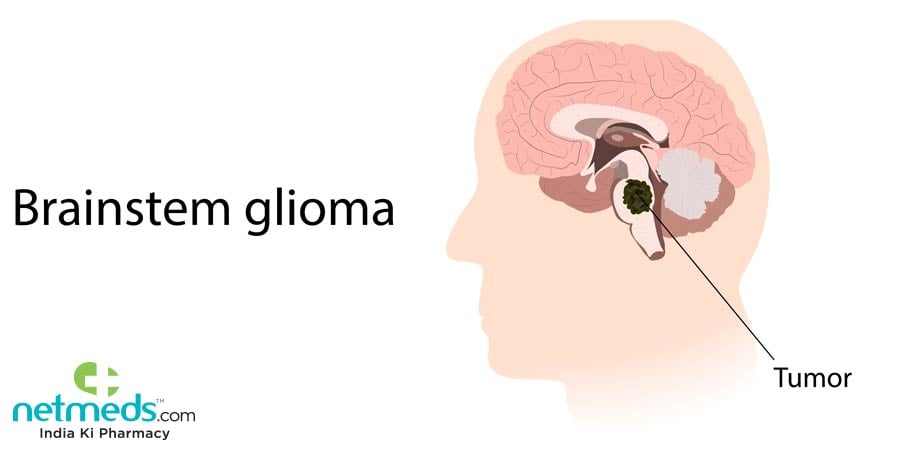 Brainstem Glioma