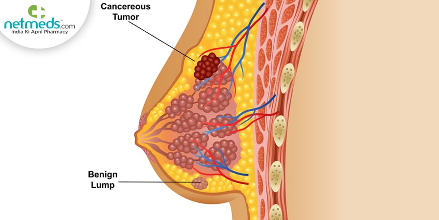 Breast Conditions