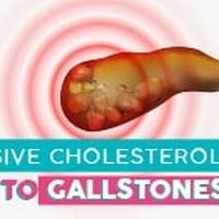 Excessive Cholesterol Leads To Gallstones