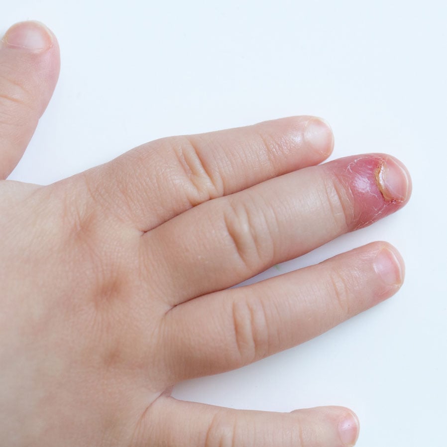 Yeast Infection in kids finger