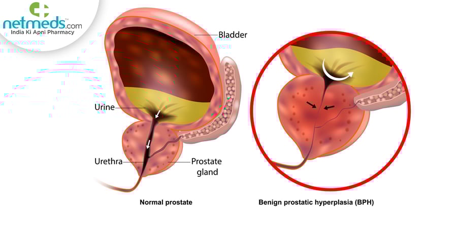 Prostatectomy