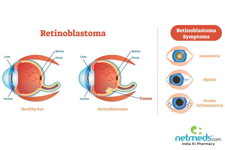 retinoblastoma
