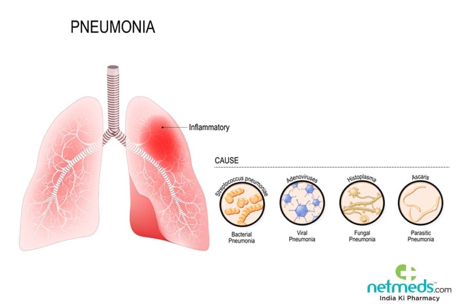 pneumonia types