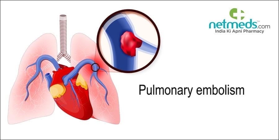 Pulmonary Embolism