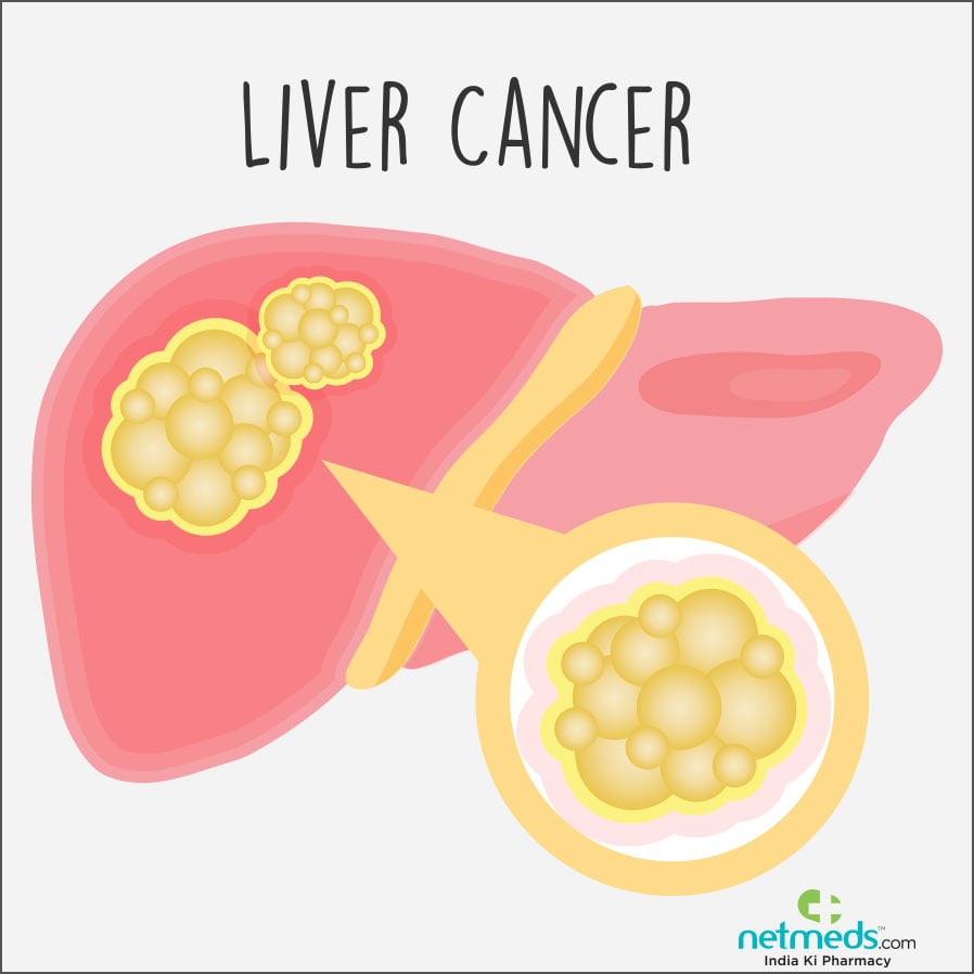 liver cancer