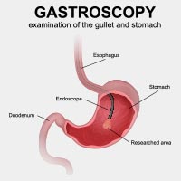 Gastroscopy: Procedure, Risks And Results